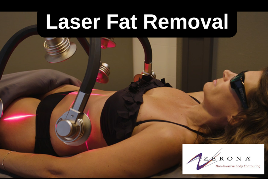 Zerona Fat Loss Laser